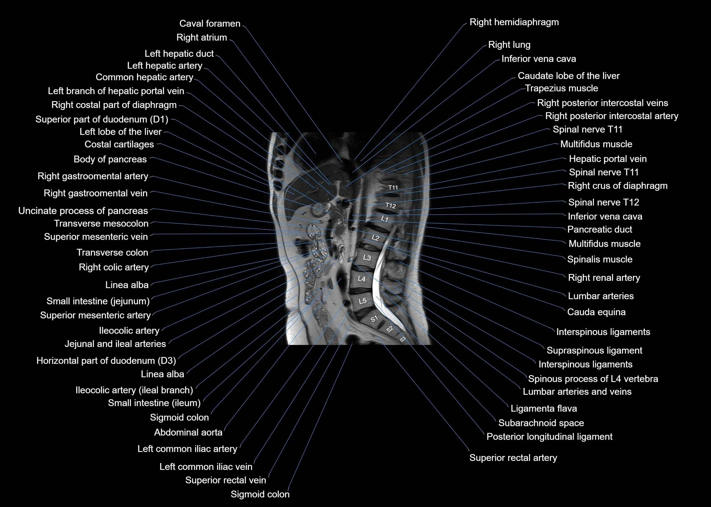 MRI abdomen sagittal cross sectional anatomy  radiology  image-img-00001-00035.webp